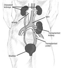 Kidney Transplant Kidney Transplant
