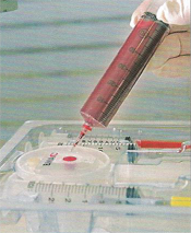 Comminuted Break - Stem Cell Therapy