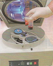Comminuted Break - Stem Cell Therapy