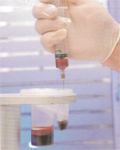 Comminuted Break - Stem Cell Therapy