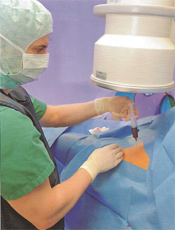 Comminuted Break - Stem Cell Therapy