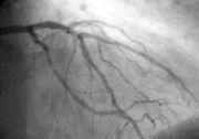 Angioplasy