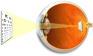 Clear Lens Extraction, intraocular Lens Clear Lens Extraction, intraocular Lens
