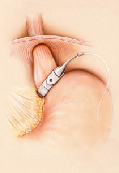Lap Band Surgery