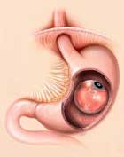 Gastric Balloon