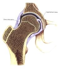 hip replacement alternative - 2 hip replacement alternative - 2