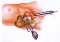 hip replacement alternative - 4 hip replacement alternative - 4