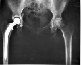 Hip Replacement Surgery Hip Replacement Surgery