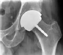 Hip Resurfacing
