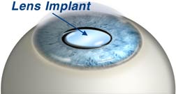 Clear Lens Extraction, intraocular Lens Clear Lens Extraction, intraocular Lens