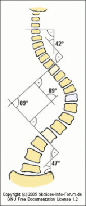 Scoliosis Scoliosis
